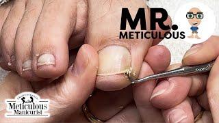 Epic Impacted Toenail Debris Removal on our favorite, Mr. Meticulous