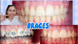 Orthodontist Shows & Explains All Before & After Braces!
