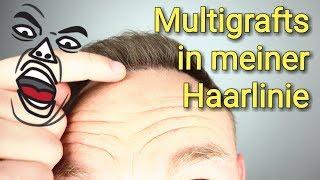 Multigrafts in meiner Haarlinie Haartransplantation /Haarausfall