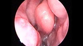 Stuffed Nose - Chronic sinusitis with muco purulent discharge & PND