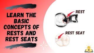 Rests and Rest Seats | The Basics | Removable Partial Denture (RPD)