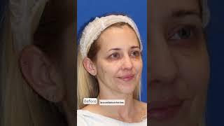 40 Year Old Woman Gets a Facelift...Her Results are STUNNING!