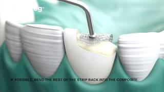 Dentapreg Class IV Restoration