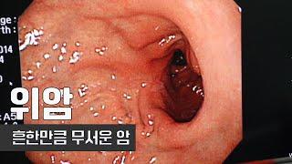 한국인에게 흔한 암, 위암 | 조기 치료하면 완치율 95%! | 건강플러스