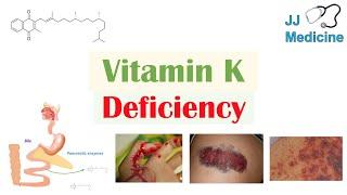 Vitamin K Deficiency | Dietary Sources, Causes, Symptoms, Diagnosis, Treatment