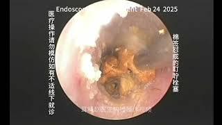 Cleaning cotton swabs can cause earwax embolism 20250224