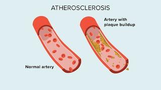 Atherosclerosis Impact on 5-Year Vascular Events in TIA/Minor Stroke: International Cohort Study