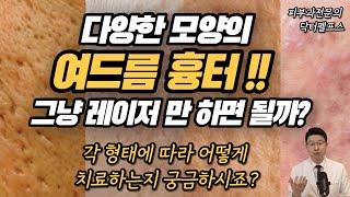 여드름흉터는 흉터 모양에 따라 치료법이 달라집니다. 각 상황별(박스카, 롤링성흉터, 아이스픽흉터)로 어떻게 치료할까요? 피부과전문의가 상세히 설명합니다.