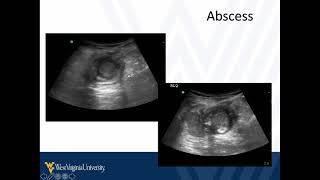 M4 Surgical Skills 2021 POCUS for Appendicitis & Other Abdominal Problems