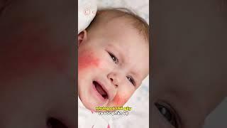 Bé 3 tuổi SỐC PHẢN VỆ do bị ONG BAY VÀO NHÀ CẮN | Dược sĩ Trương Minh Đạt