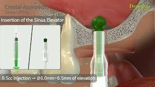 Dentium Total Solution for Sinus (Crestal Approach)