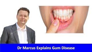 What is a Gum Disease actually ? Explained by Dr Marcus Spry