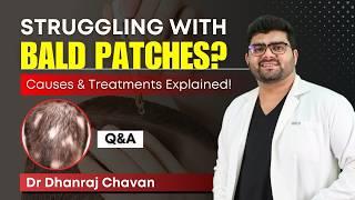 Battling Bald Patches? Effective Treatments for Alopecia Areata | Hair Loss Treatment | HairMD, Pune