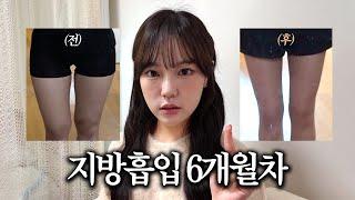 허벅지 지흡 반년 후, 충격적인 뒷이야기