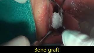 healing abutment tenting