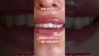 Total verspritzte Lippen! Da hilft nur Hylase! #lippenaufbau #hylase #auflösen #beautytips