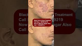 Best Black Peel on Acne Treatment at Skinaa Clinic | Viral #shorts