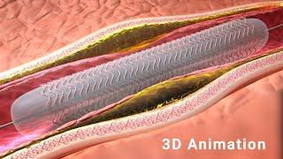 Balloon Angioplasty Procedure : 3D Animation