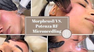 What is the Difference between Morpheus8 and Potenza RF Microneedling at SEV Laser