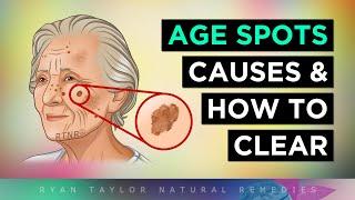 The Real Causes of AGING SPOTS