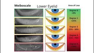 Eyedeology Eye School: What is Meibomian Gland Dysfunction (MGD)?