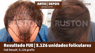 #Resultado #FUE - 3.126 unidades foliculares | #FUE #Result - 3.126 grafts