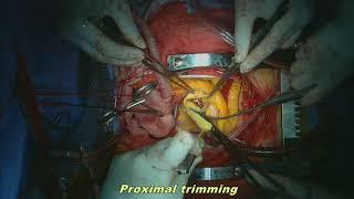 Total arch replacement with frozen elephant trunk (E-vita) in Retrograde type IA aortic dissection