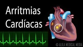 Arritmias Cardíacas, Animación. Alila Medical Media Español.