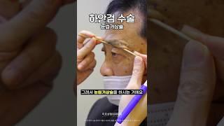 중년 눈성형  눈썹거상술 + 하안검 상담받고 수술한 1달차 후기 (미호 시그니처 눈밑성형)