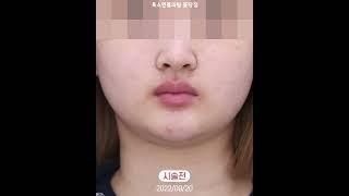 빈약한 입술이 도톰히 변신~ 입술필러, 입꼬리필러 고고