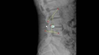 TraumaCad - Lumbar Lordosis Angle