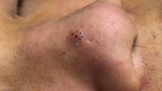 Popping huge blackheads and Giant Pimples - Best Pimple Popping Videos #182