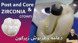 Broken Tooth Repair FIBER POST & CORE filling after Root Canal and Zirconia crown