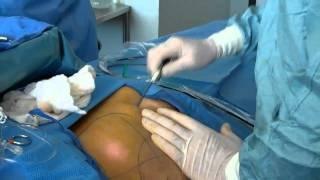 SmartLipo Pasadena - Liposuction Los Angeles, CA