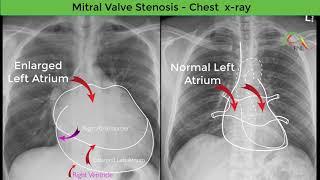 Mitral Valve Stenosis on a Chest x-ray