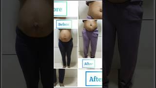 Diastasis Recti repair: Arogya physiotips #diastasisrectirecovery