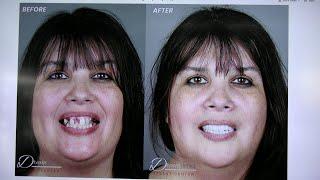 Jaw dropping All ON 4 Smile Transformation