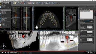 Introduction to Guided Surgery (Everything Blue Sky Plan - Part 1)