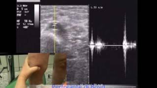 Stripping Fantasma -  varici vene varicose chiva laser scleromousse, veneinforma