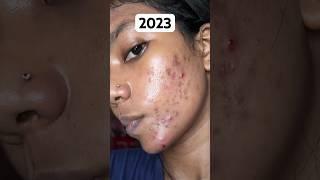 2023 to 2024 My acne treatment journey #shorts #skincare #acnetreatment #pimple #viral