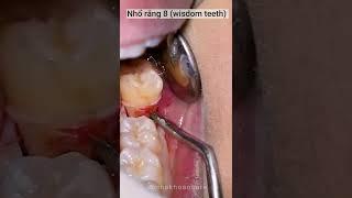 Nhổ răng 8 (wisdom teeth) #nhakhoa #dentist #teeth