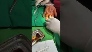 Lipoma removal د غدود تداوی