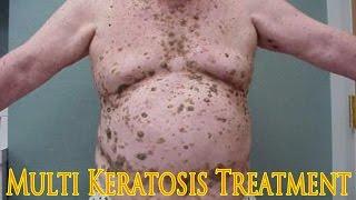 MULTI KERATOSIS. Treatment by Liquid Nirtogen. Dr. Duzhy / Множественные кератомы. Лечение.