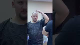 HAIR TRANSPLANT  METHODS FUE 5000 GRAFT - Dermatolog Dr. Mustafa TÜMTÜRK