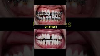 Braces evolution #braces #orthodontist #dentist #dental