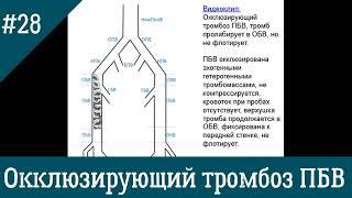 УЗИ вен. Окклюзирующий тромбоз ПБВ.