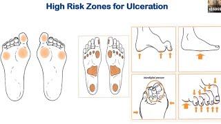 Diabetic Foot Ulcers and Infections