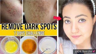 In 7 Days  Remove DARK SPOTS, ACNE SCARS, PIMPLE MARKS, PIGMENTATION in just 7 Days | 100% Results