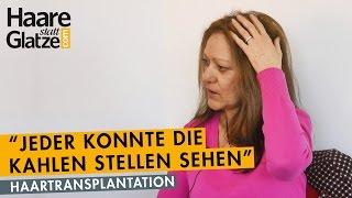 Haartransplantation bei einer Frau: 1200 FUs am Oberkopf