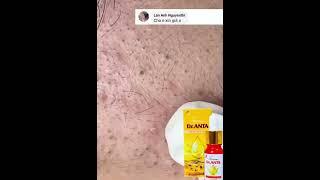 nó đây rồi #trùm trị mụn Kim Thúy #antaski #dranta #nanmun